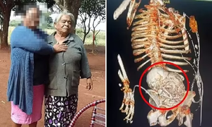 Cụ bà 81 tuổi chết sau khi loại bỏ bào thai bị vôi hóa trong cơ thể suốt 56 năm