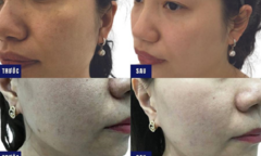 Da láng mịn, se khít lỗ chân lông bằng Clinic Laser cùng TMV Ngọc Dung