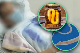 Ăn mật rắn, uống rượu rắn, người đàn ông nhiễm trùng tuỷ sống nghiêm trọng