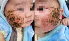 Người nhà tự đắp lá cây chữa viêm da, bé 4 tháng tuổi bị loét má nặng