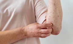 Ghi nhận 78 ca nghi mắc sởi và rubella, Bộ Y tế chỉ đạo nóng