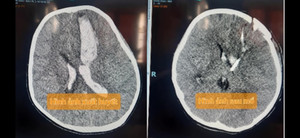 Cứu 3 trẻ xuất huyết não do vỡ mạch máu