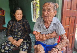 Người phụ nữ nghèo bất lực nhìn chồng con đau đớn vì khối u chiếm toàn bộ cơ thể