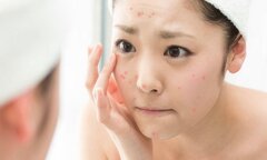 Hướng dẫn cách chăm sóc da mụn vào mùa hè
