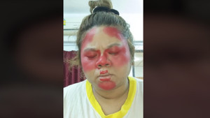 Hậu quả của việc 'đu trend' trang điểm trên mạng 