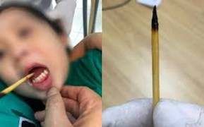 Bé 3 tuổi bị que xiên thịt đâm xuyên lưỡi sau cú ngã