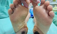 Suýt liệt vĩnh viễn do sử dụng phương pháp dân gian trị đau cột sống
