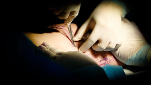 Suy giãn tĩnh mạch chân: Dấu hiệu và biến chứng