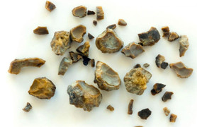 Vị trí cơ thể có thể hình thành sỏi