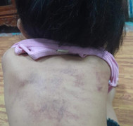 Bé 5 tuổi tím bầm lưng: Phân công 3 giáo viên phụ trách lớp làm nhiệm vụ khác