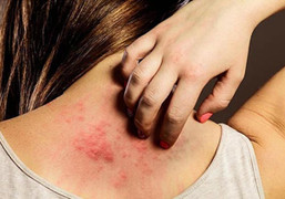 Khổ sở vì cứ đến hè lại bị nổi mẩn, ngứa khắp người