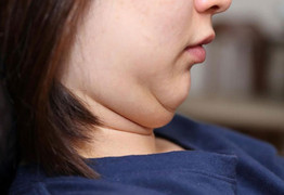 5 mẹo đơn giản giúp bạn giảm mỡ mặt mà không cần động dao kéo