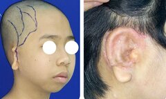 Bé 5 tuổi lép nửa mặt, dị tật tai nhỏ được phẫu thuật thành công