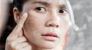 Mách bạn mẹo làm mờ vết đồi mồi trên da nhanh chóng