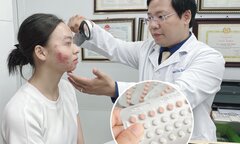 Rước họa vào thân sau khi uống thuốc tránh thai khẩn cấp để trị mụn