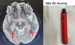 Nam sinh tổn thương não, tim vì hút thuốc lá điện tử trộn ma túy