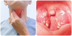 Các biến chứng khó lường của bệnh bạch hầu