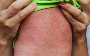 Bộ Y tế chỉ đạo nóng ngăn chặn bùng phát dịch sởi, ho gà