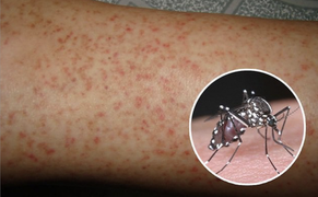 Hà Nội ghi nhận thêm 11 ổ dịch sốt xuất huyết trong một tuần