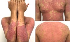 Căn bệnh khiến chàng trai da đỏ, sần sùi như khúc gỗ