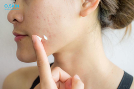 Gel trị mụn Megaduo Plus: Cơ chế hoạt động và tác dụng