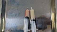 Cấp cứu người đàn ông bị mỡ máu 'đông đặc'