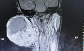 Suýt mất mạng vì mang khối u khổng lồ 14 năm không điều trị