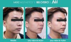 Belotero Revive: Chất làm đầy chứa HA liên kết chéo và Glycerol