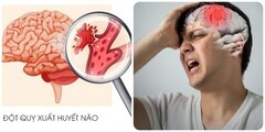 Đột quỵ não nguy hiểm thế nào?