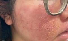 'Nát mặt' vì mua mỹ phẩm trị mụn theo quảng cáo trên mạng