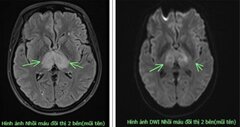 Đau đầu suốt 4 ngày không khỏi, đi khám mới biết mắc bệnh nguy hiểm, hiếm gặp