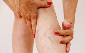 Suy giãn tĩnh mạch chân có nên đi bộ?