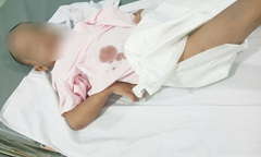Bé 6 tuổi ở TP.HCM nghi bị bạo hành đến tổn thương gan, nhiễm trùng vết bỏng