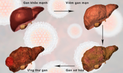 Heposal - Giải pháp hỗ trợ phục hồi chức năng gan và giảm xơ hóa hiệu quả