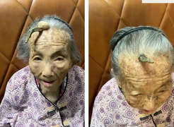 Kỳ lạ chiếc 'sừng trường thọ' dài 10cm trên trán cụ bà 107 tuổi 