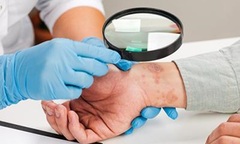 Tự ý điều trị ngứa, nam thanh niên bị nấm mọc toàn thân