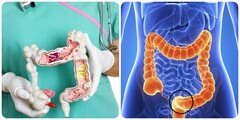 Bị ung thư đại tràng sống được bao lâu?