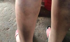 Nam sinh lớp 6 ở Quảng Nam bị cô giáo đánh bầm tím 2 chân