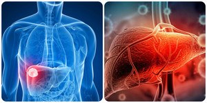 Những dấu hiệu cảnh báo ung thư gan giai đoạn đầu