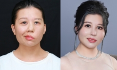 Cô gái 'mặt méo' lột xác sau 3 cuộc đại phẫu