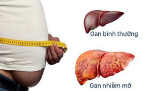 Người bị gan nhiễm mỡ bao lâu nên đi khám một lần?