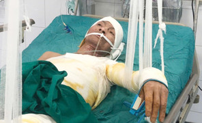 Ngã vào bãi rác đang cháy, người đàn ông bị bỏng nặng cần giúp đỡ