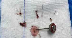 Bé trai 2 tuổi cắn cục pin, pin nổ gây nát miệng