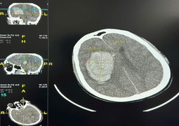 Số ca đột quỵ do tắm khuya gia tăng 