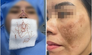 Thủng mũi sau 3 tháng làm đẹp ở spa