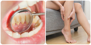 Thiếu canxi có tác hại gì?