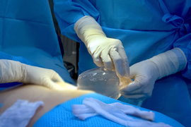 Biến chứng nhiễm trùng âm thầm khi tháo túi ngực