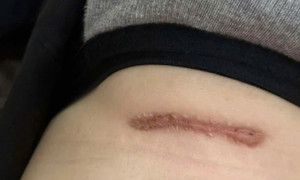 Giải pháp cắt sẹo lồi hiệu quả tại phòng khám Edopi