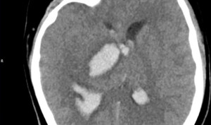 Thiếu niên 15 tuổi tử vong sau cơn đau đầu đột ngột