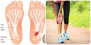 Tác hại của việc đi bộ quá nhiều